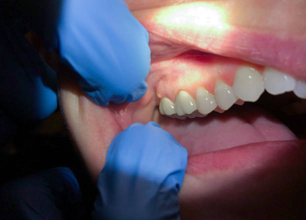 Best Emergency Dental Surgery in Pistakee Highlands, IL